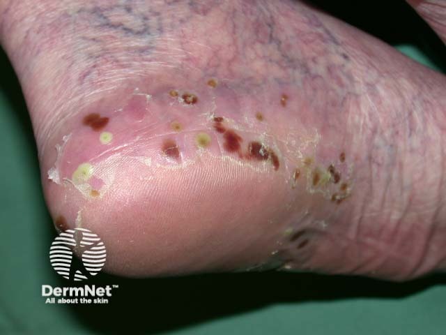 Plantar pustulosis