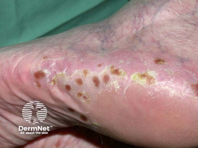 Plantar pustulosis