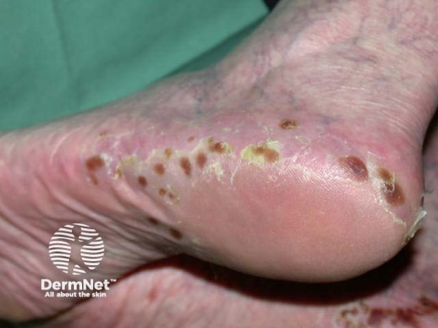 Plantar pustulosis