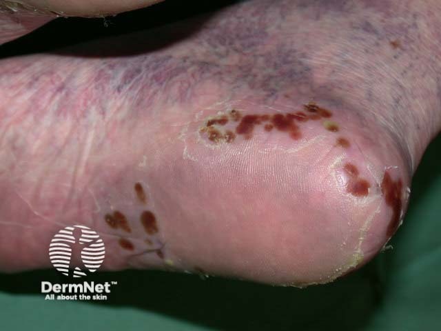 Plantar pustulosis