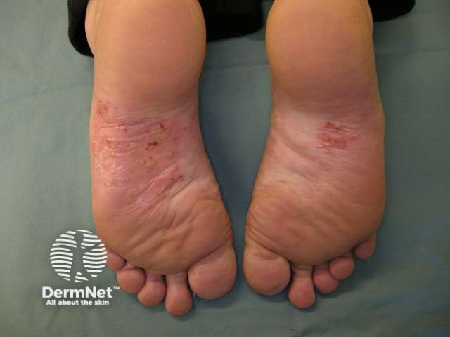 Plantar pustulosis