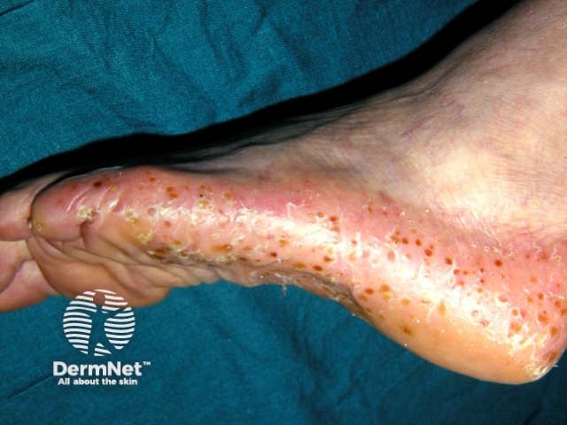 Plantar pustulosis