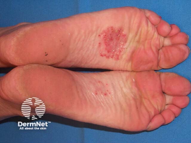 Plantar pustulosis