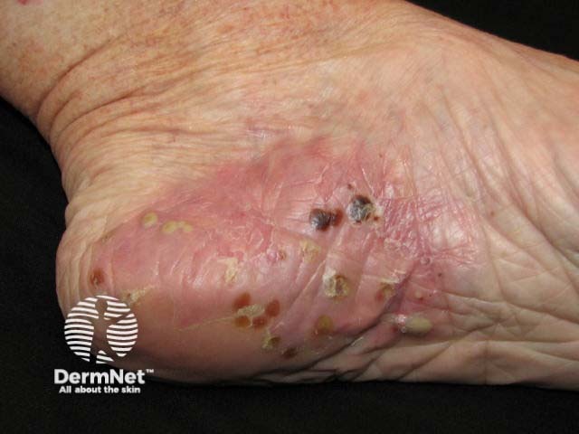 Plantar pustulosis