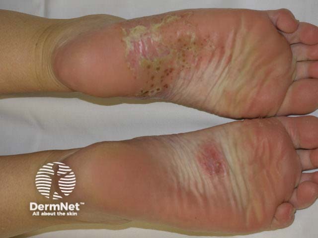 Plantar pustulosis