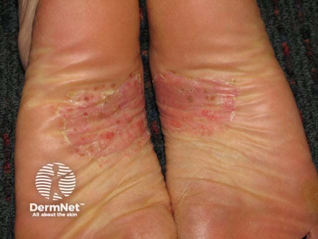 Plantar pustulosis