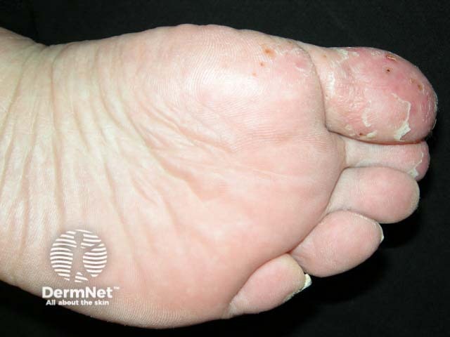 Plantar pustulosis