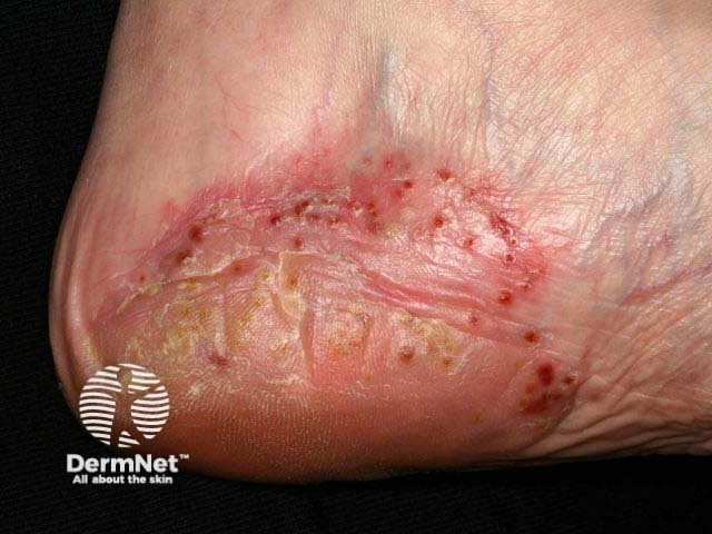 Plantar pustulosis