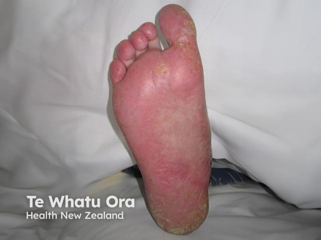 Plantar pustulosis