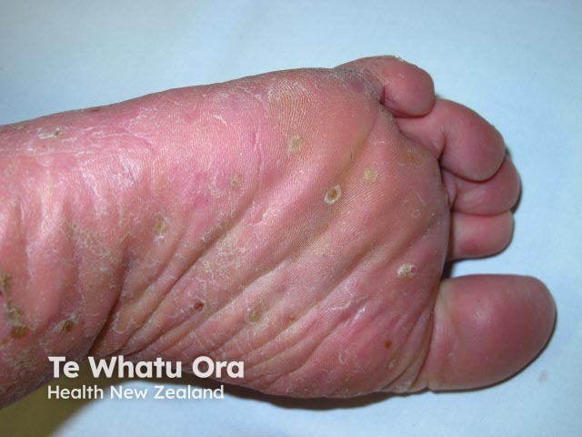 Plantar pustulosis