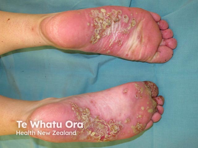 Plantar pustulosis