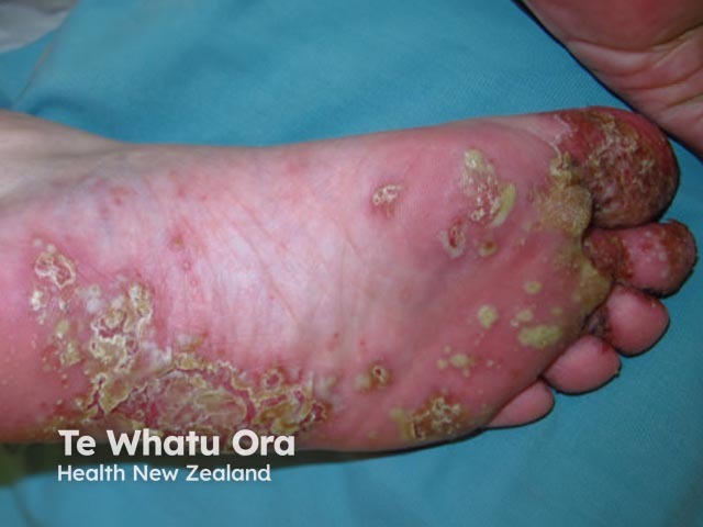 Plantar pustulosis