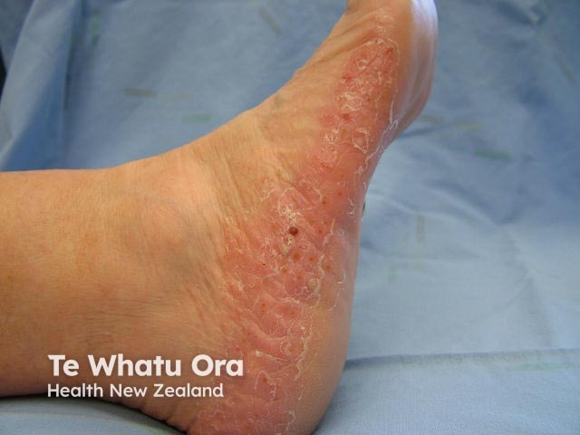 Plantar pustulosis