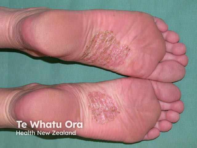 Plantar pustulosis