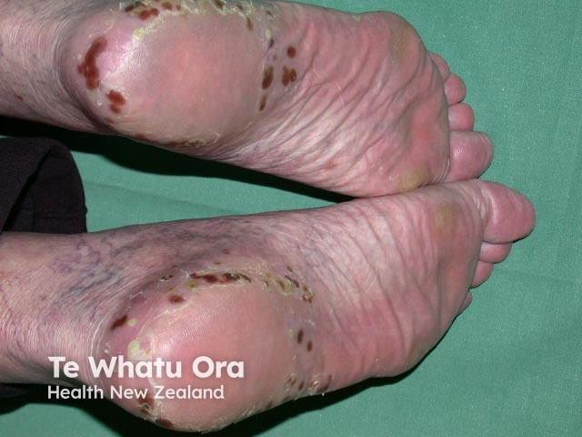 Plantar pustulosis