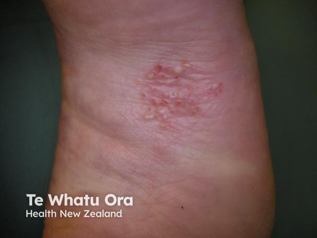 Plantar pustular psoriasis