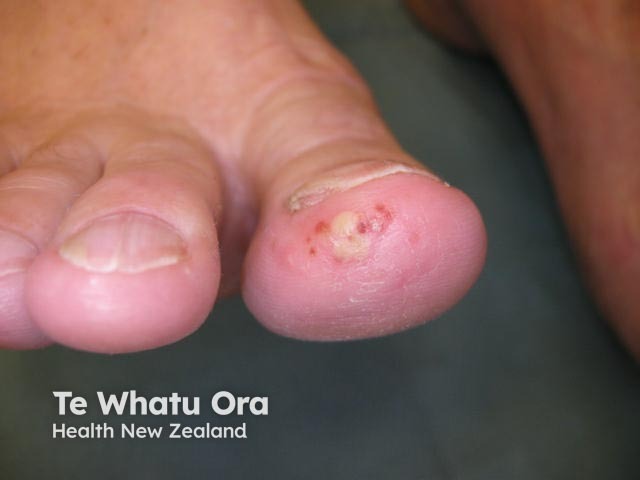 Plantar pustulosis