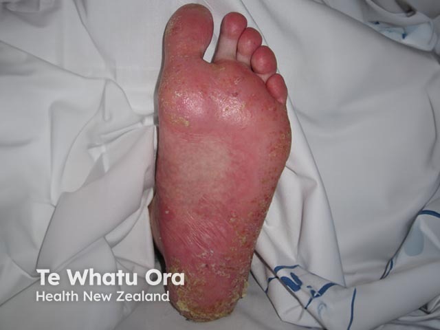 Plantar pustulosis