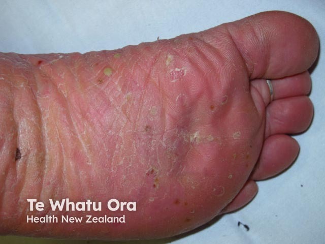 Plantar pustulosis