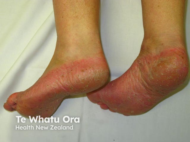 Plantar pustulosis