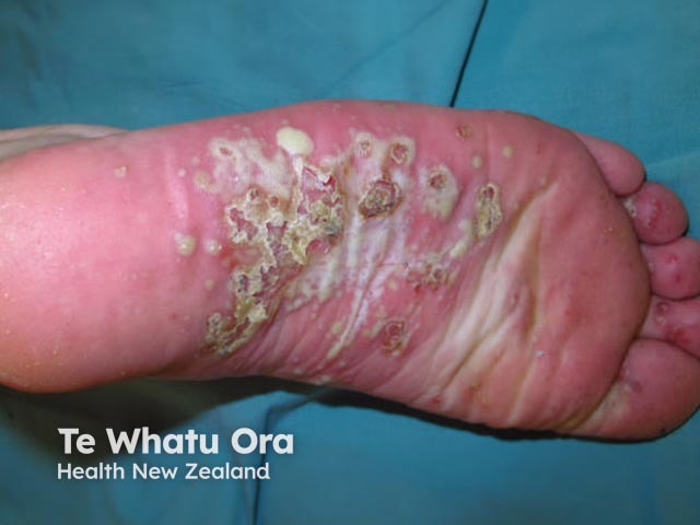 Plantar pustulosis