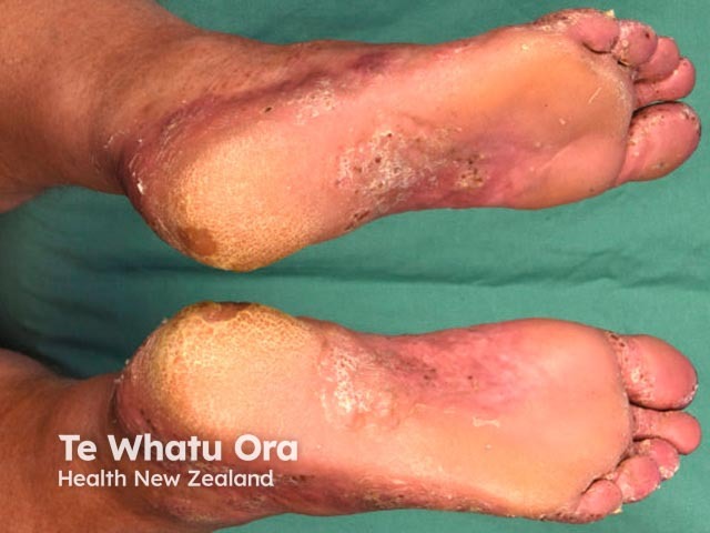 Plantar pustulosis