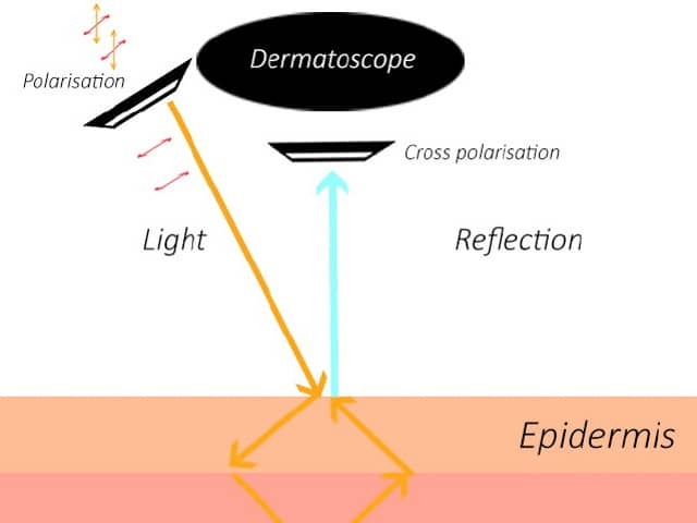 Polarised dermoscopy