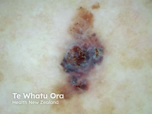 Polarised dermoscopy of melanoma