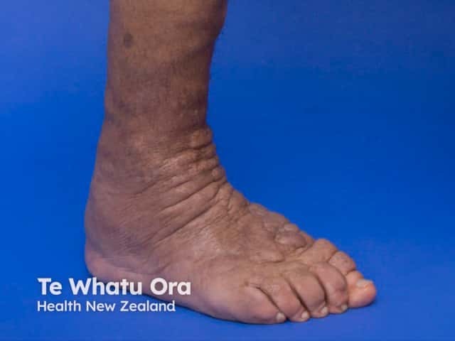 Pretibial myxoedema in Graves disease