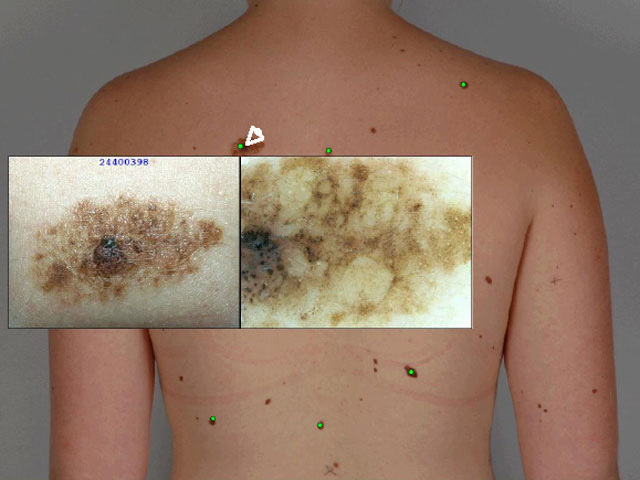 Macro and dermoscopy images of lesion of concern