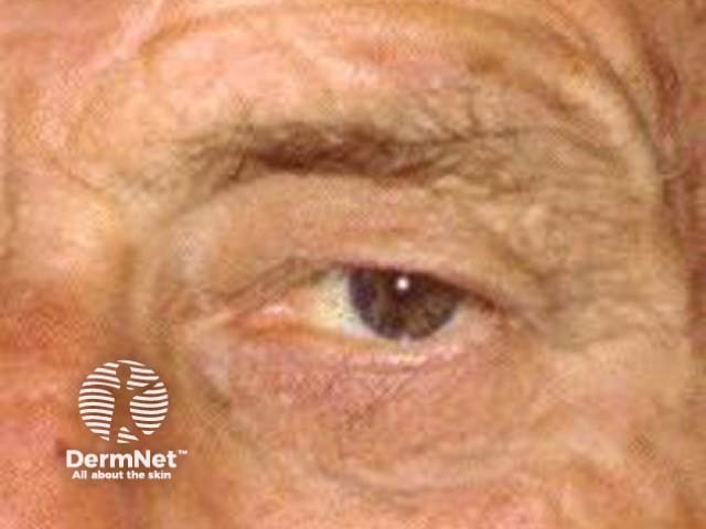 Before laser eyelid surgery