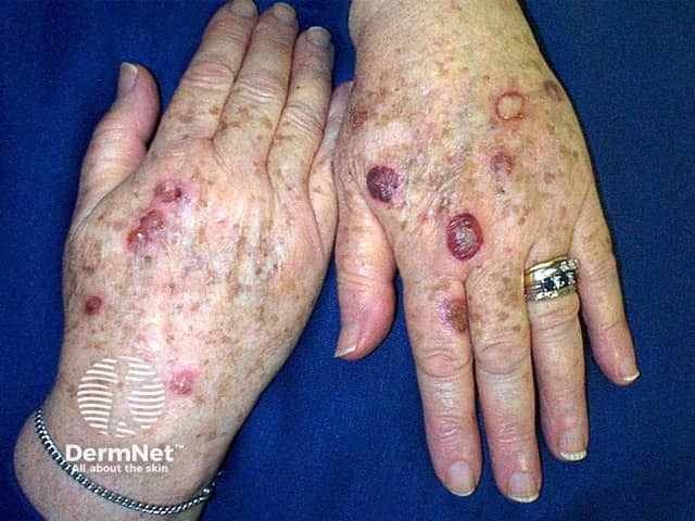 Haemorrhagic blisters 3 days after treatment