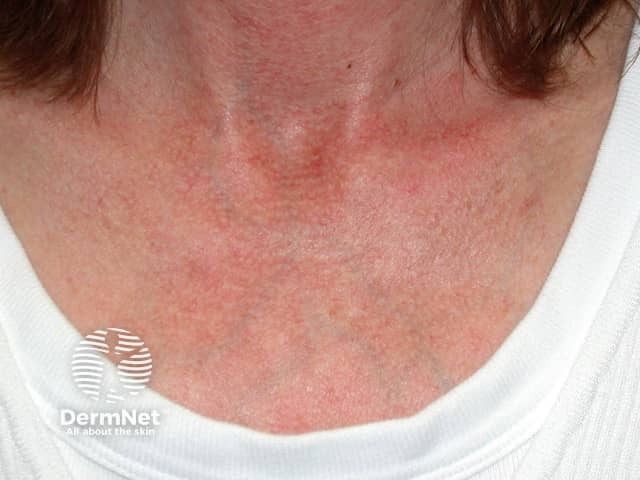 Hypopigmentation following IPL