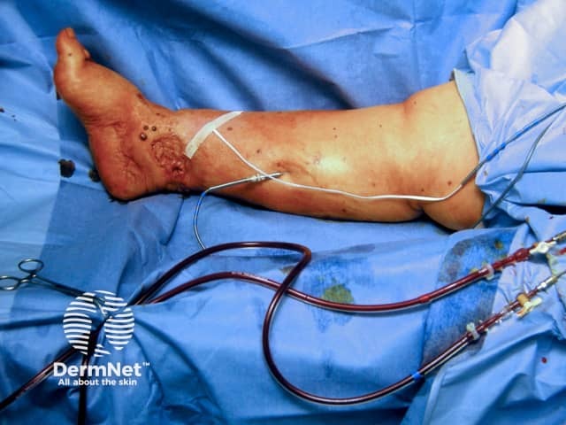 Isolated limb perfusion