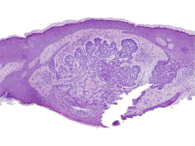 BCC on histopathology