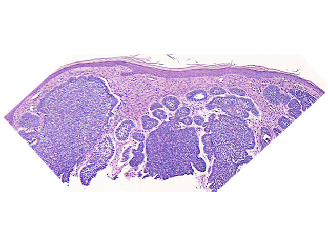 BCC on histopathology