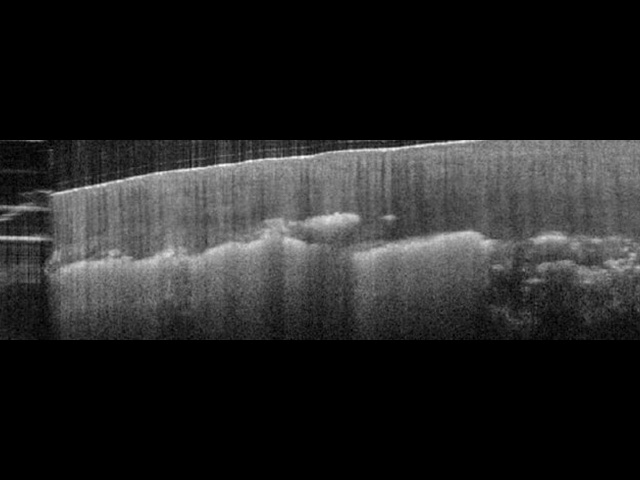 Hyperreflective patches, distal nail