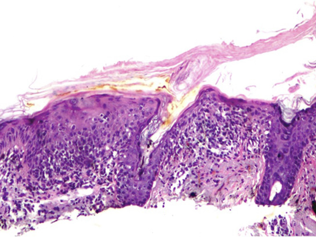 Histopathology of actinic keratosis