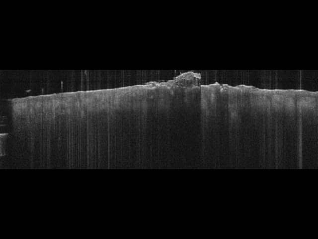 Vertical shadowing from surface scaling (OCT), same lesion