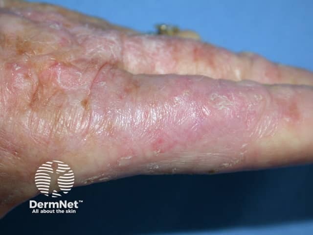 Actinic keratoses