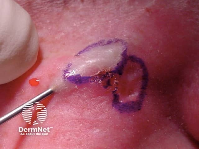 Subcision procedure