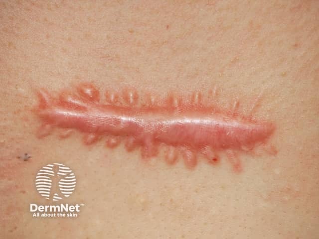 Hypertrophic scar