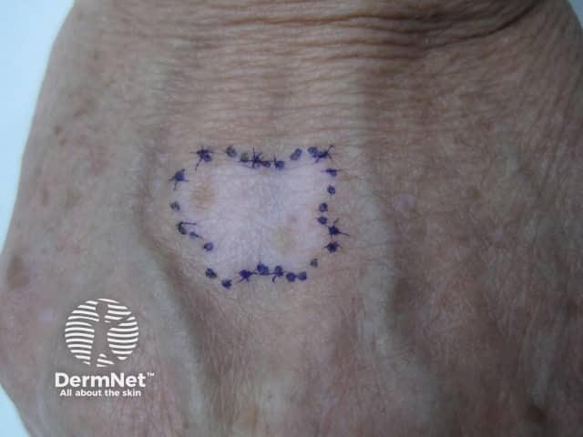 Vitiligo surgery