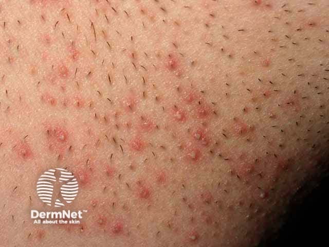 Pseudofolliculitis barbae