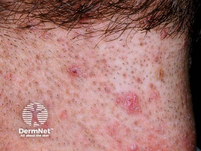 Pseudofolliculitis barbae