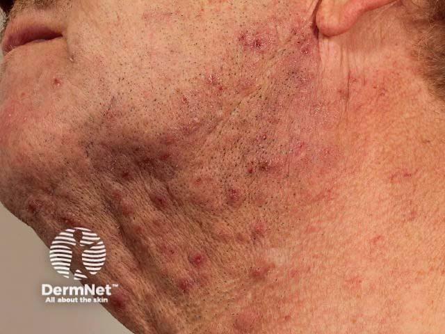 Pseudofolliculitis barbae