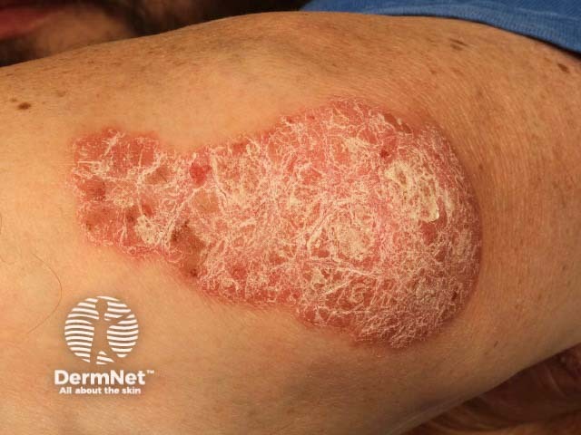 Chronic plaque psoriasis of elbow