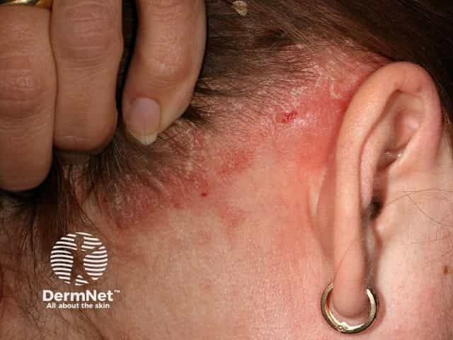 Scalp psoriasis