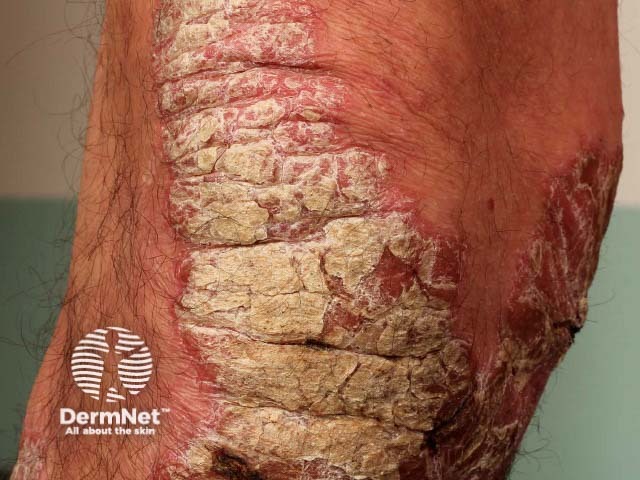 Chronic plaque psoriasis