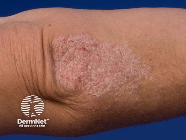 Chronic plaque psoriasis